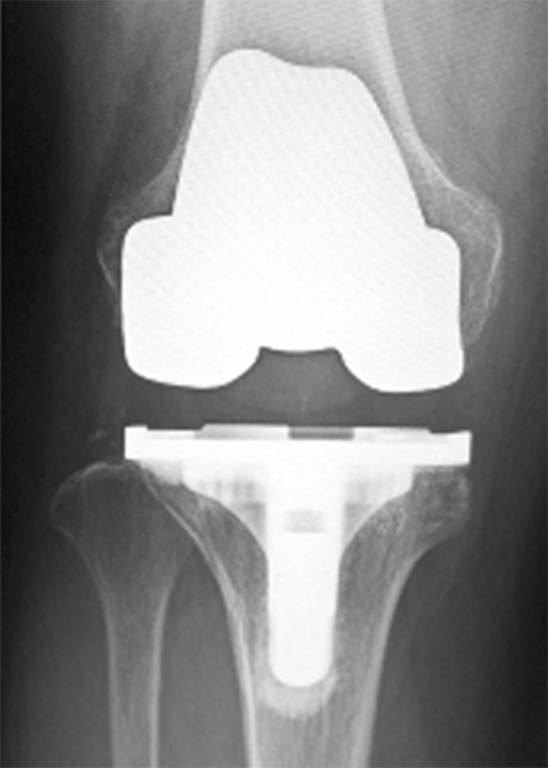 人工膝関節置換術後