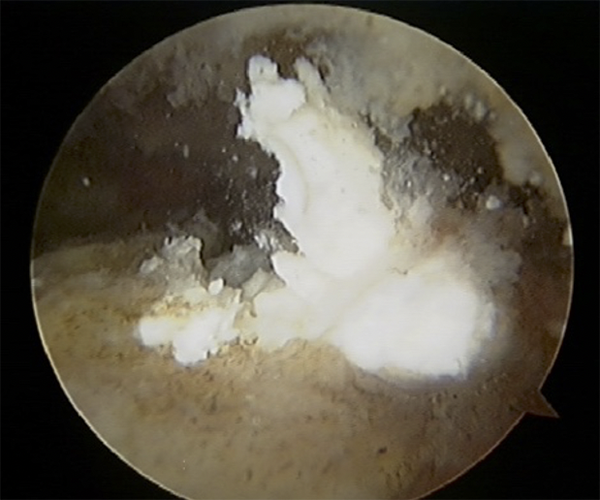 関節鏡所見：腱表面から噴出する石灰